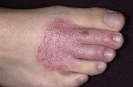 eczema
